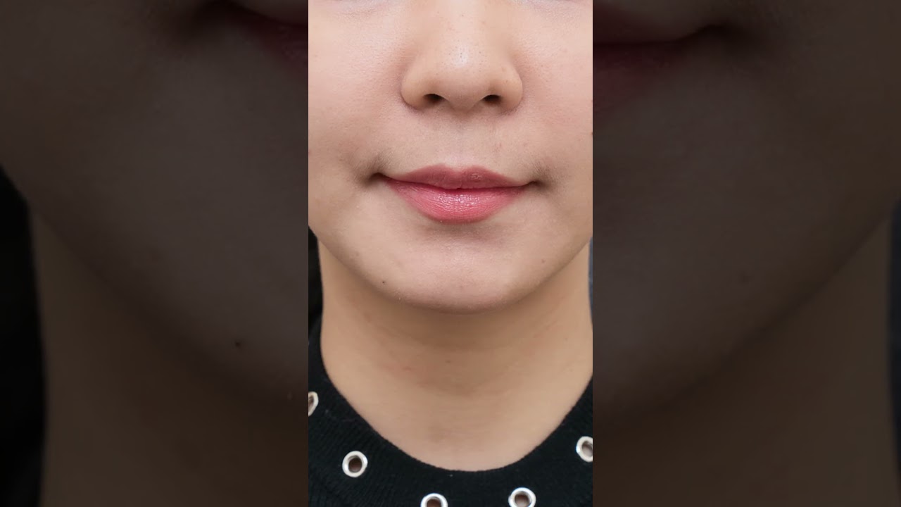 เลเซอร์กำจัดหนวด ผู้หญิงก็ทำได้! - Skinity Clinic