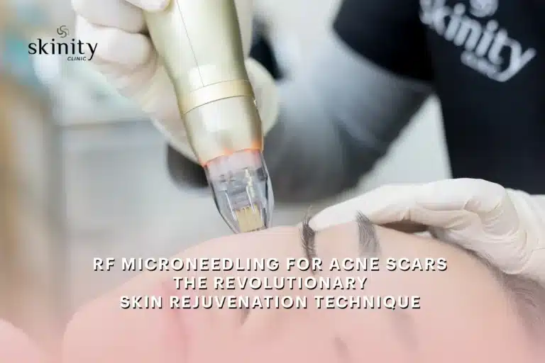 RF Microneedling for Acne Scars: The Revolutionary Skin Rejuvenation Technique