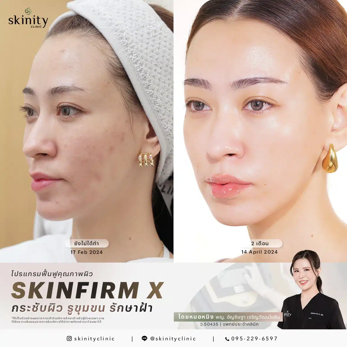 รีวิว Sylfirm X Plus