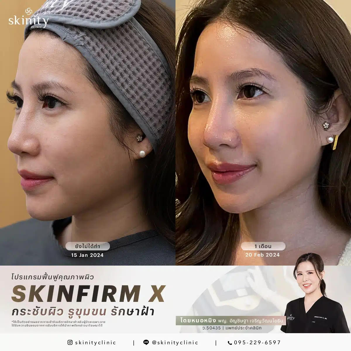 รีวิว Sylfirm X Plus