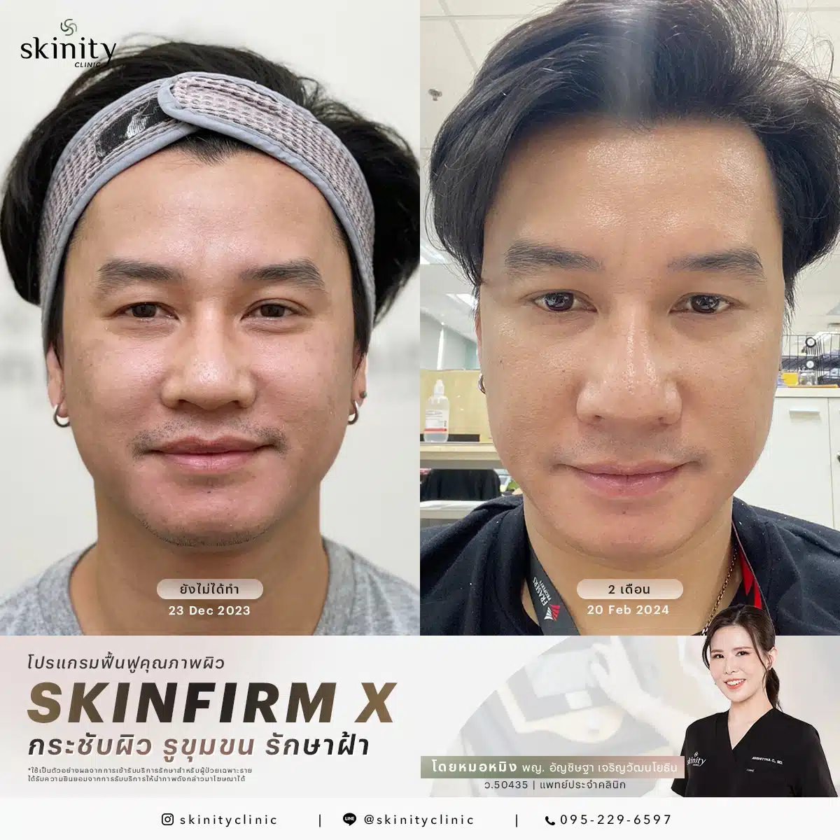 รีวิว Sylfirm X Plus