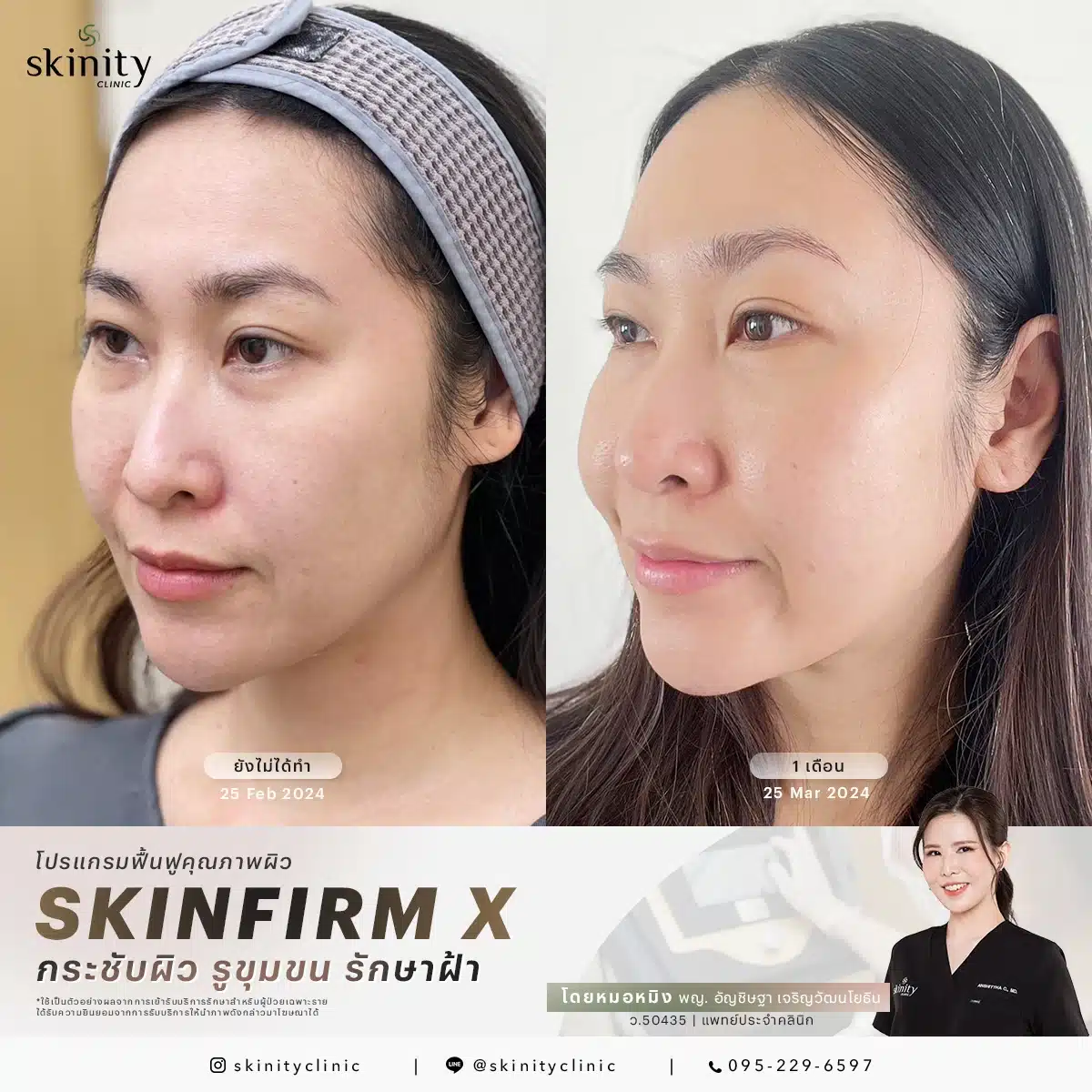 รีวิว Sylfirm X Plus