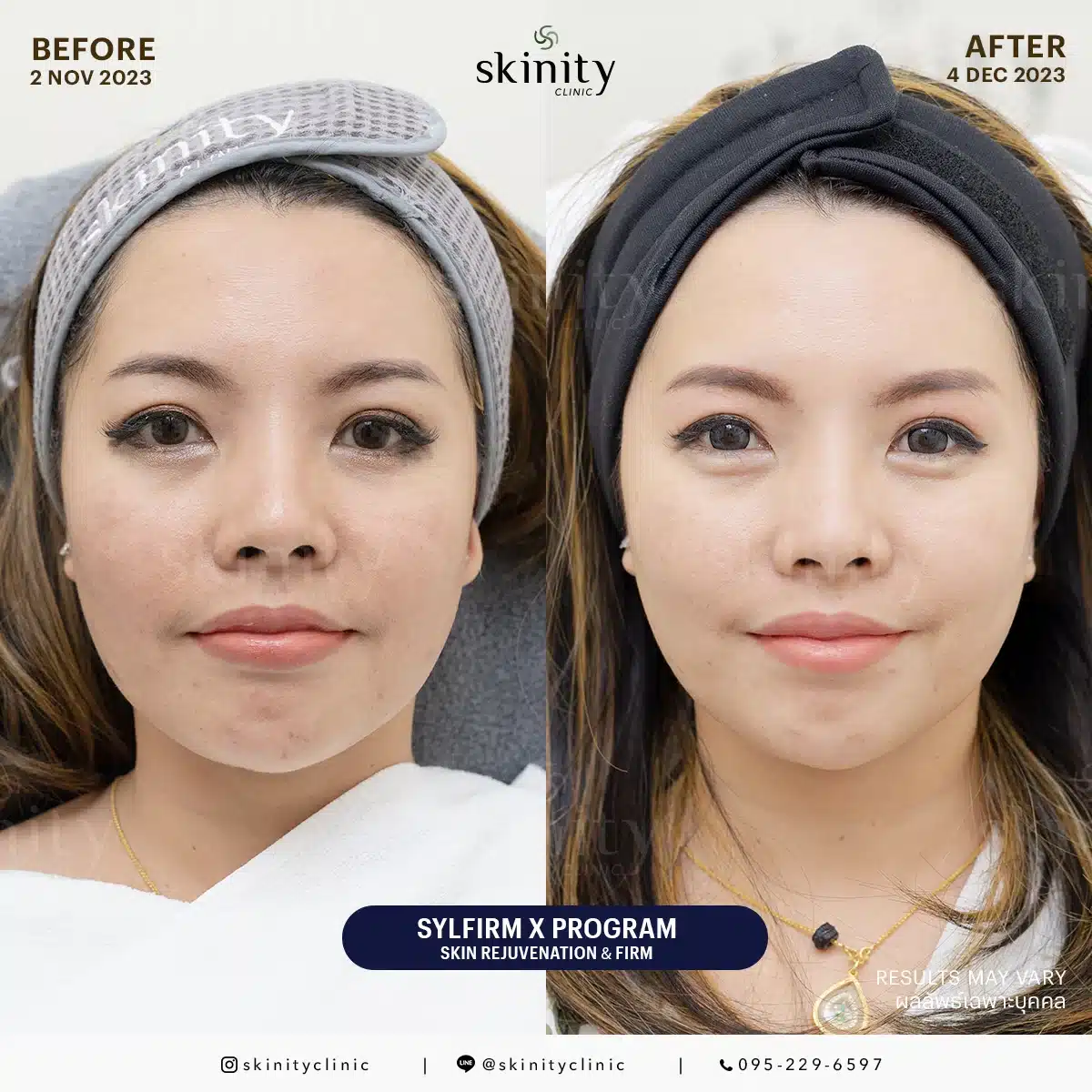 รีวิว Sylfirm X Plus