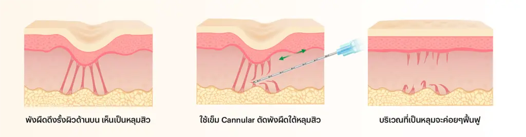 การรักษาหลุมสิวด้วย Cannular Subcision