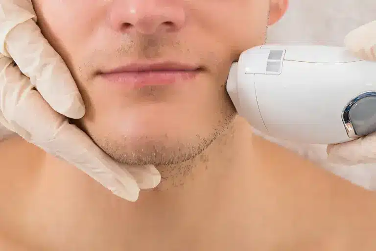 เลเซอร์หนวดผู้ชายด้วย Diode Laser คืออะไร? กำจัดขนให้หน้าเกลี้ยงอย่างปลอดภัย